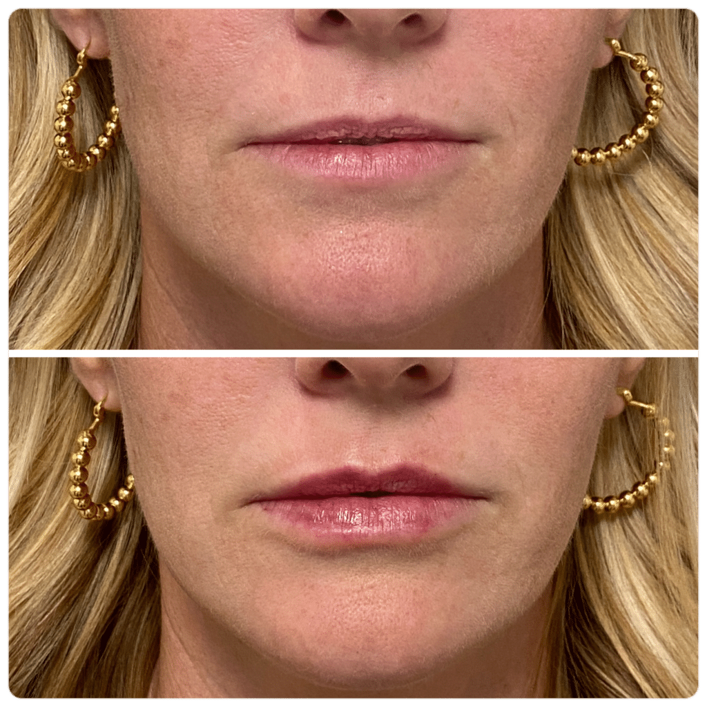 Before and After Image: Botox + Filler - front