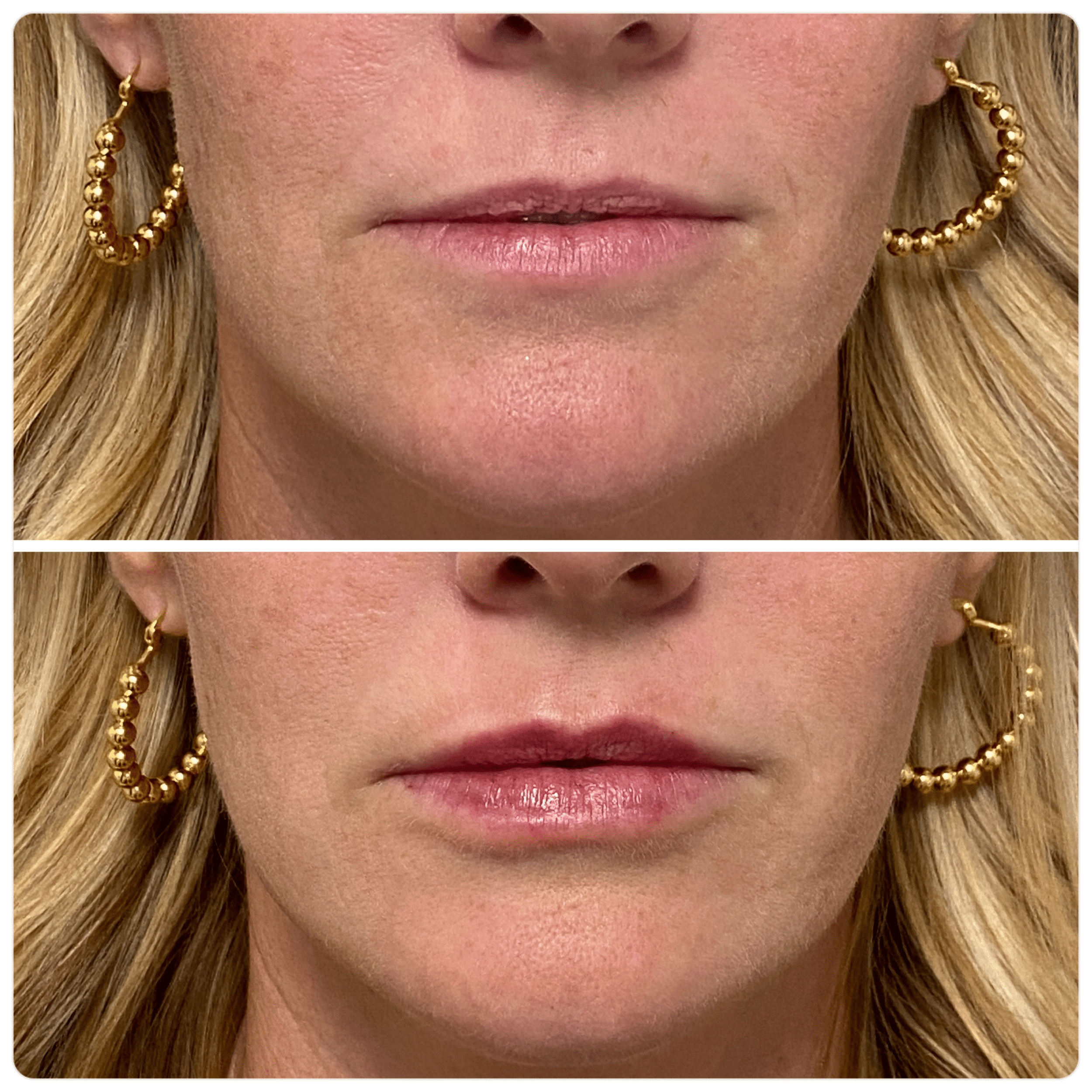 Before and After Image: Botox + Filler - front