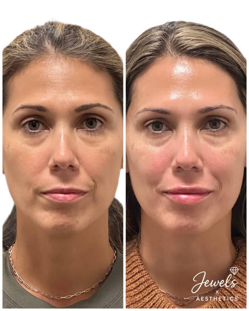 Before and After Image: Botox + Filler - front