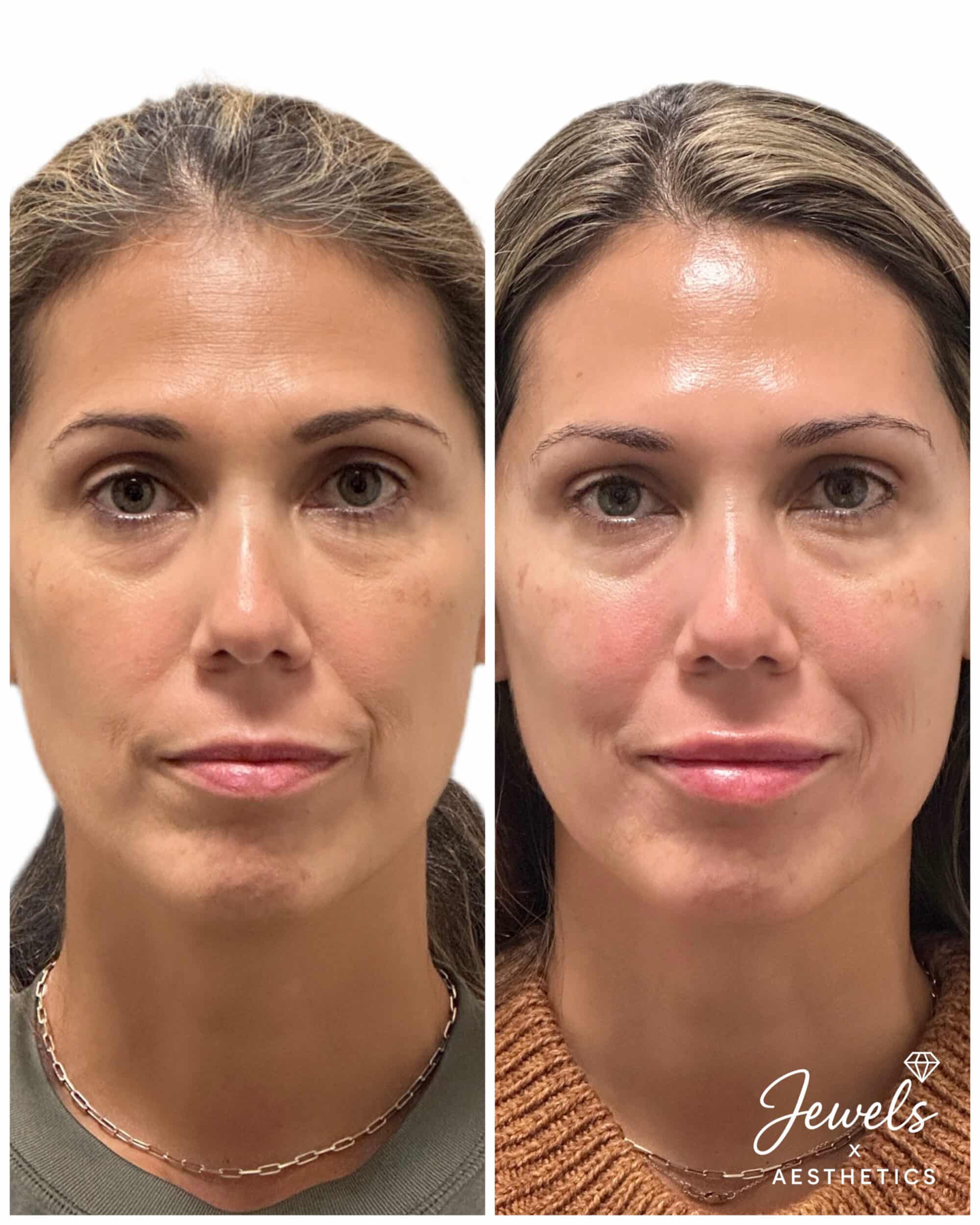 Before and After Image: Botox + Filler - front