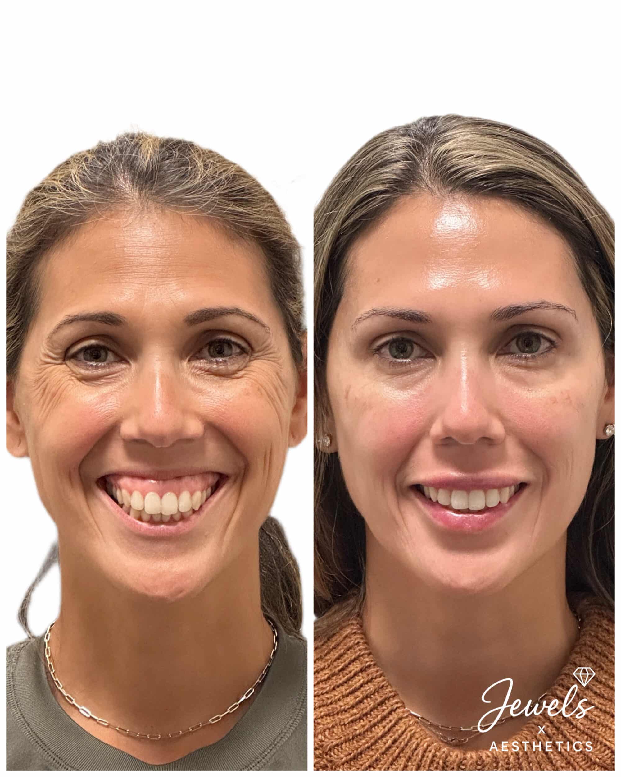 Before and After Image: Botox + Filler - front