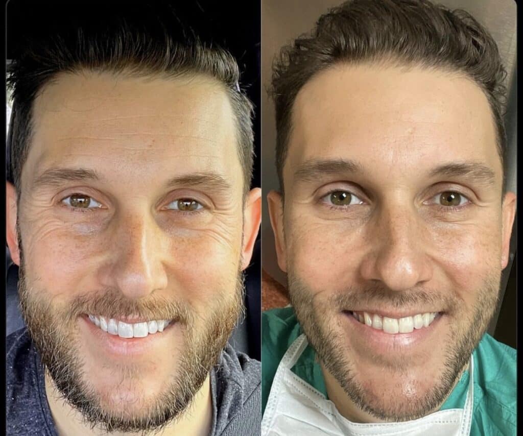 Before and After Image: Botox - front