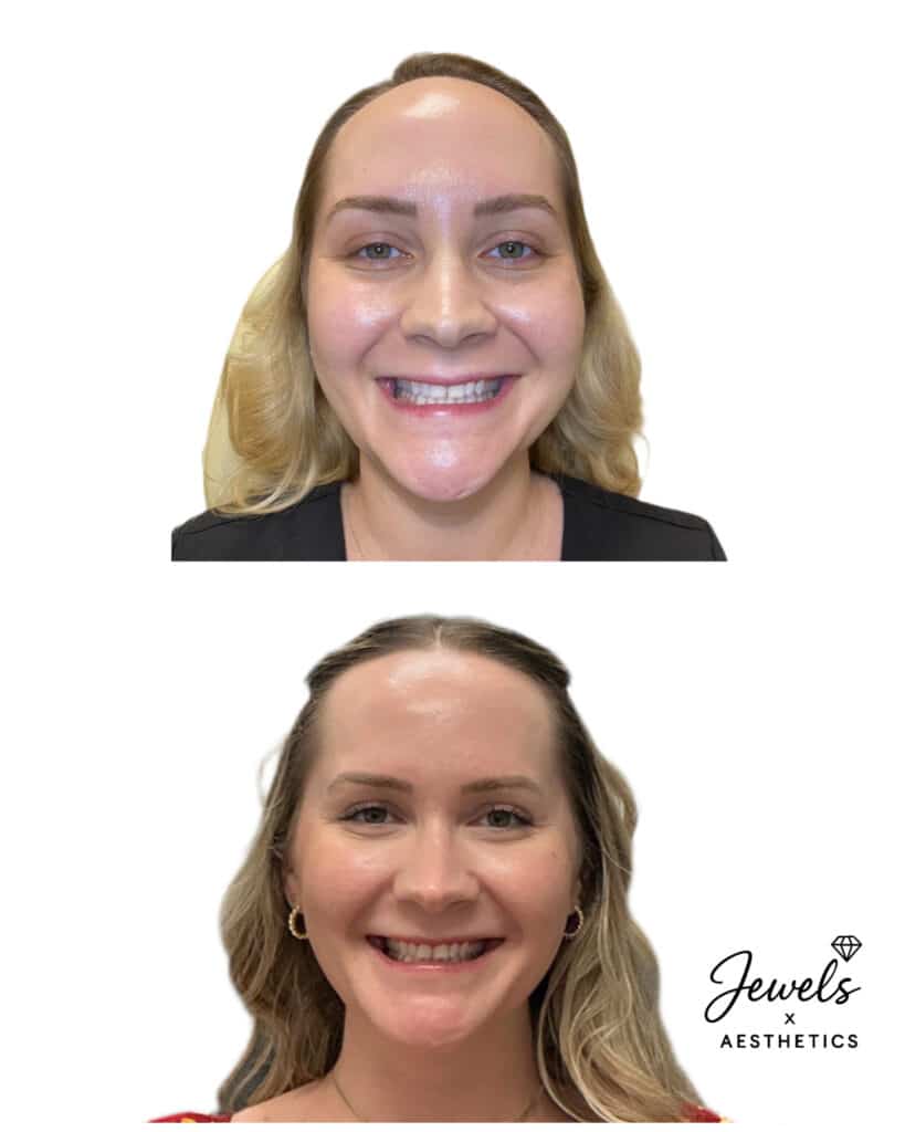 Before and After Image: Facial Balancing - front