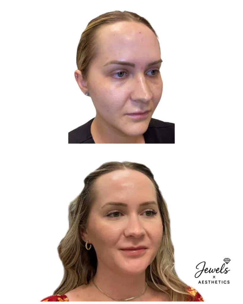 Before and After Image: Facial Balancing - right-front-oblique
