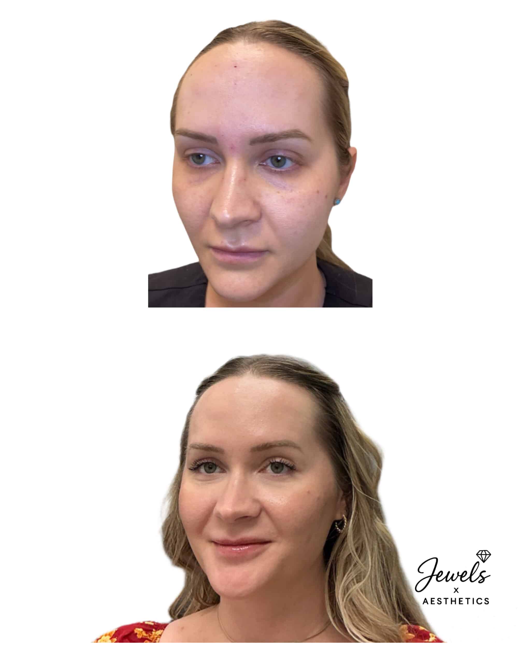 Before and After Image: Facial Balancing - left-front-oblique