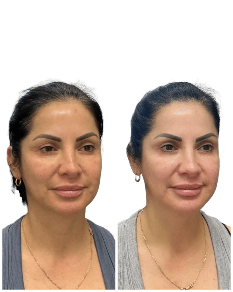 Before and After Image: Facial Balancing - right-front-oblique