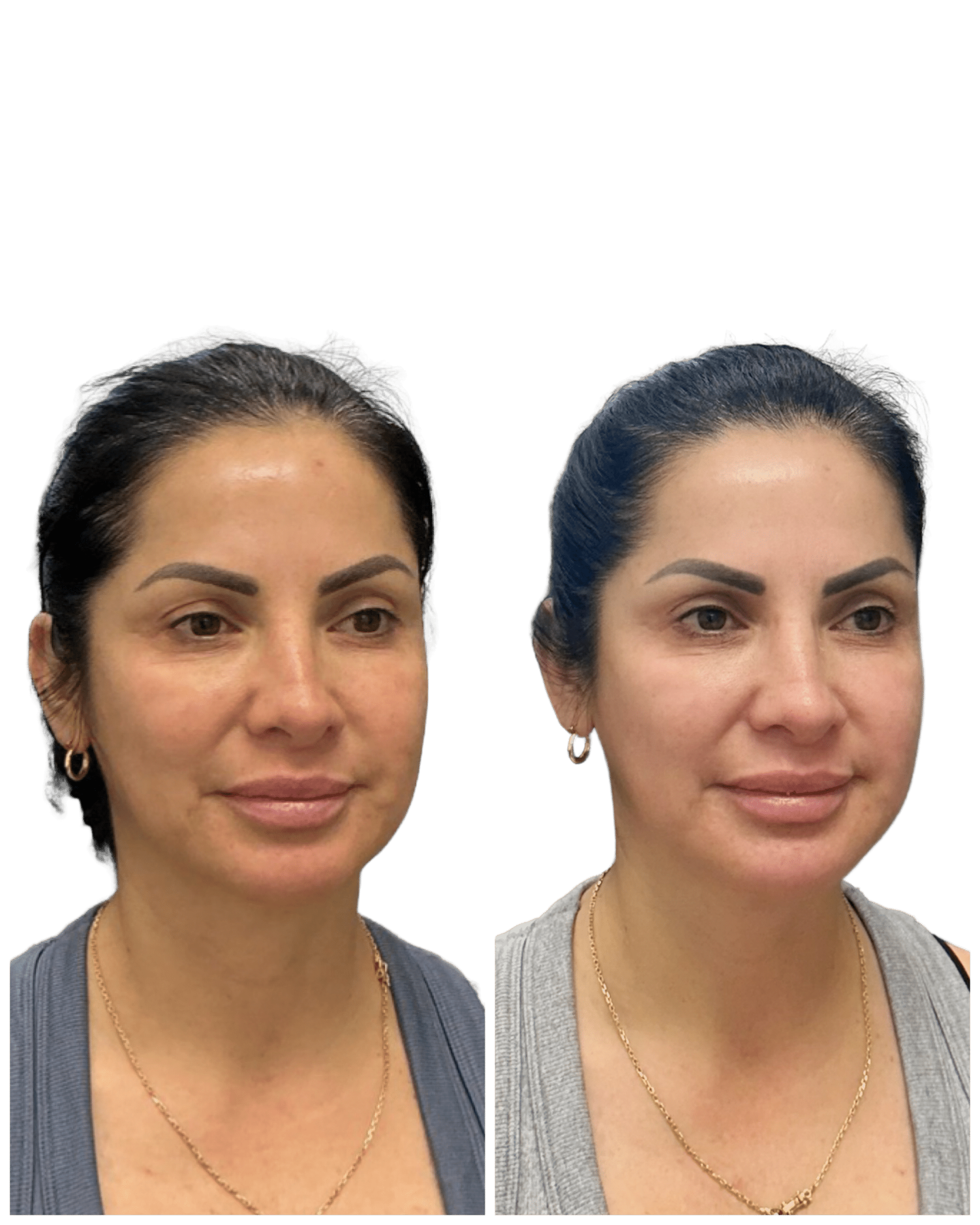 Before and After Image: Facial Balancing - right-front-oblique