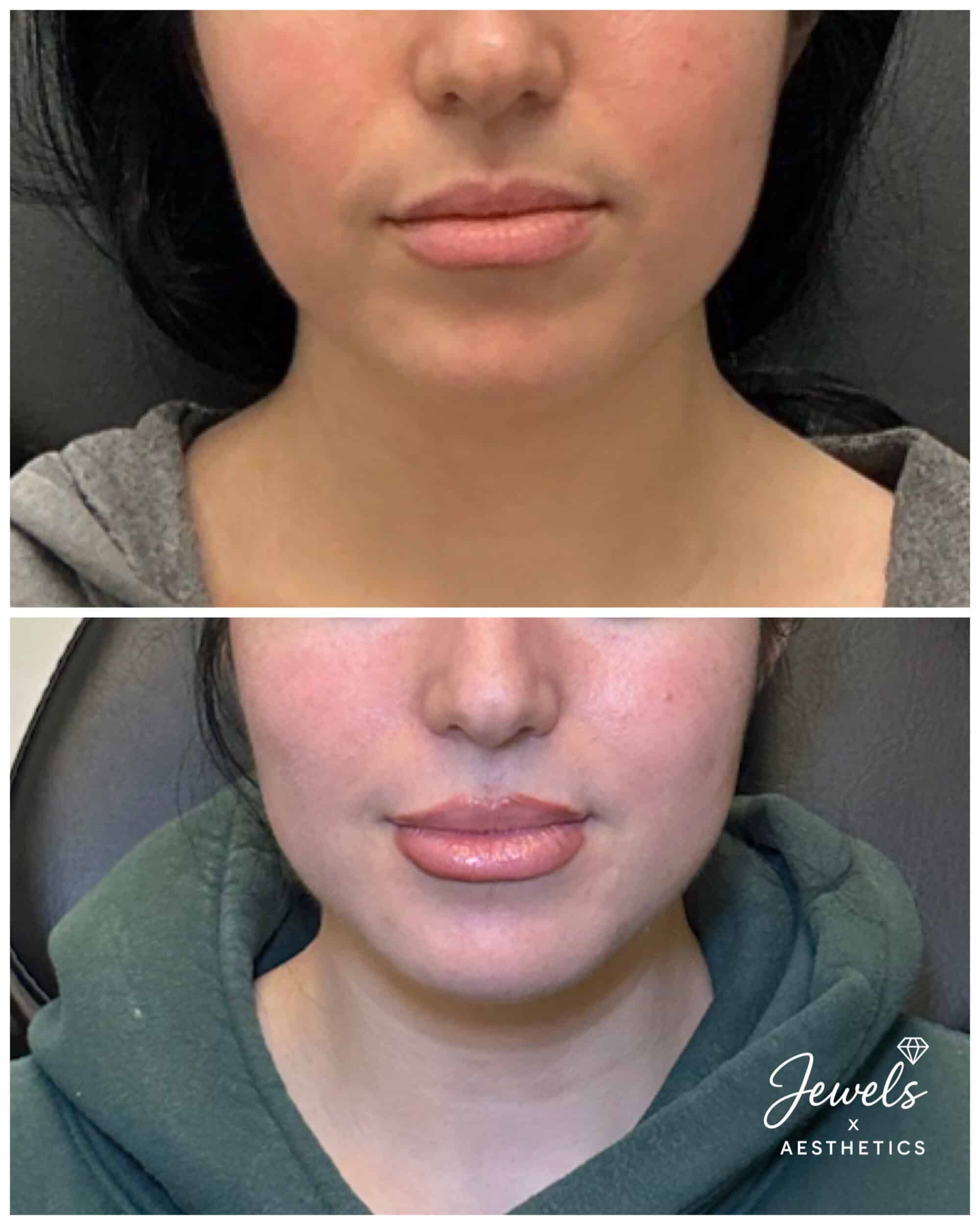 Before and After Image: Lip Filler - front