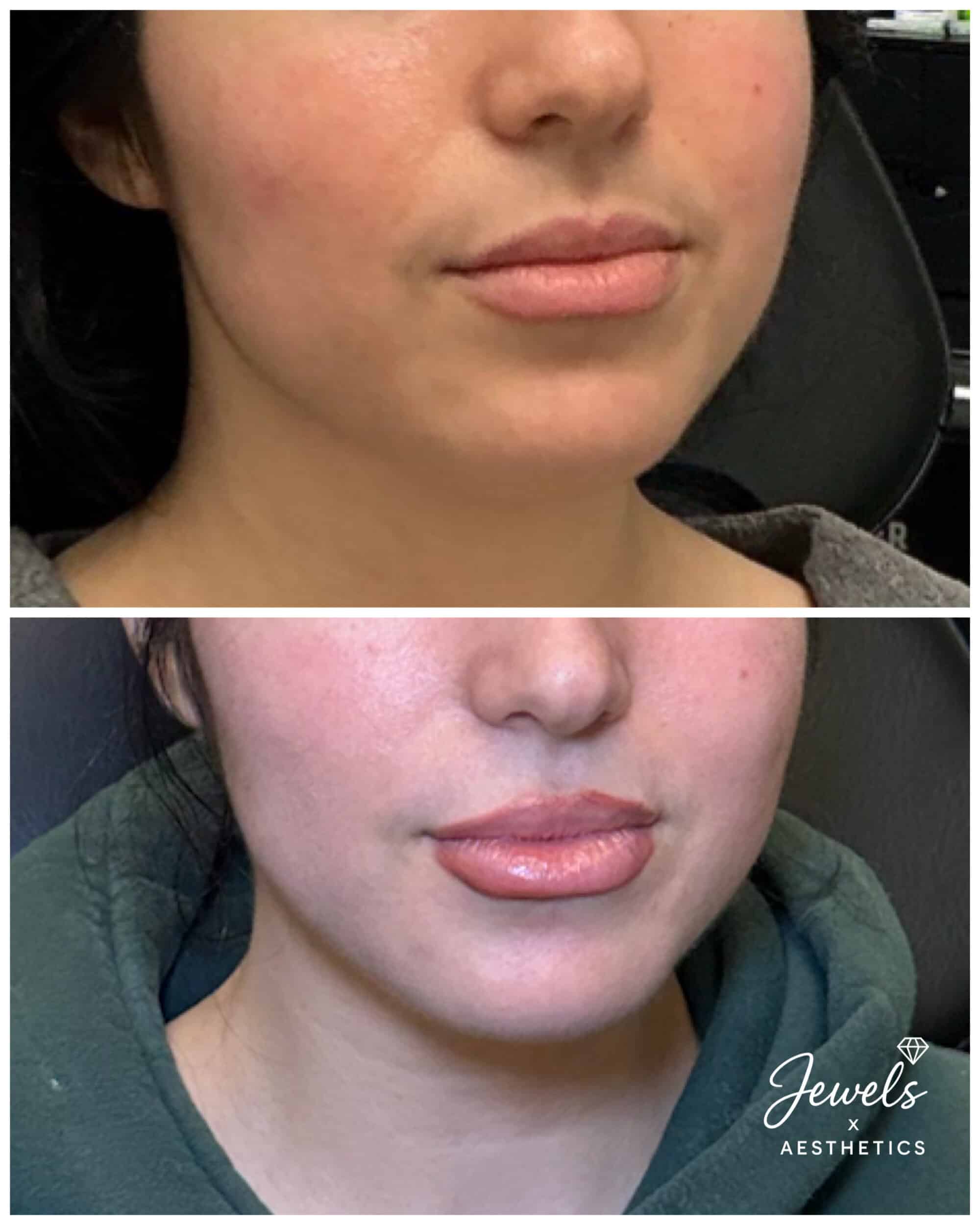 Before and After Image: Lip Filler - right-front-oblique