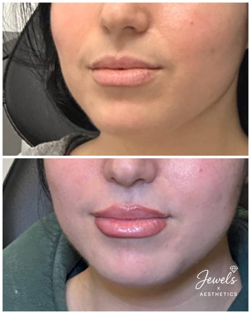 Before and After Image: Lip Filler - left-front-oblique
