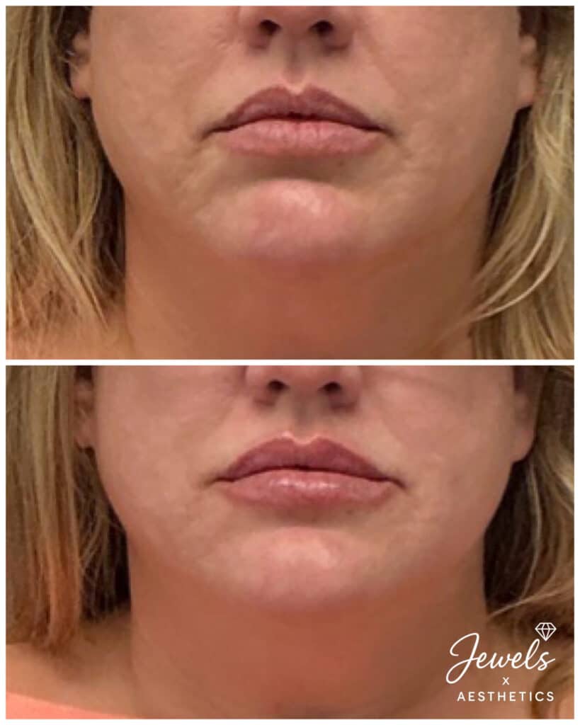 Before and After Image: Lip Filler - front