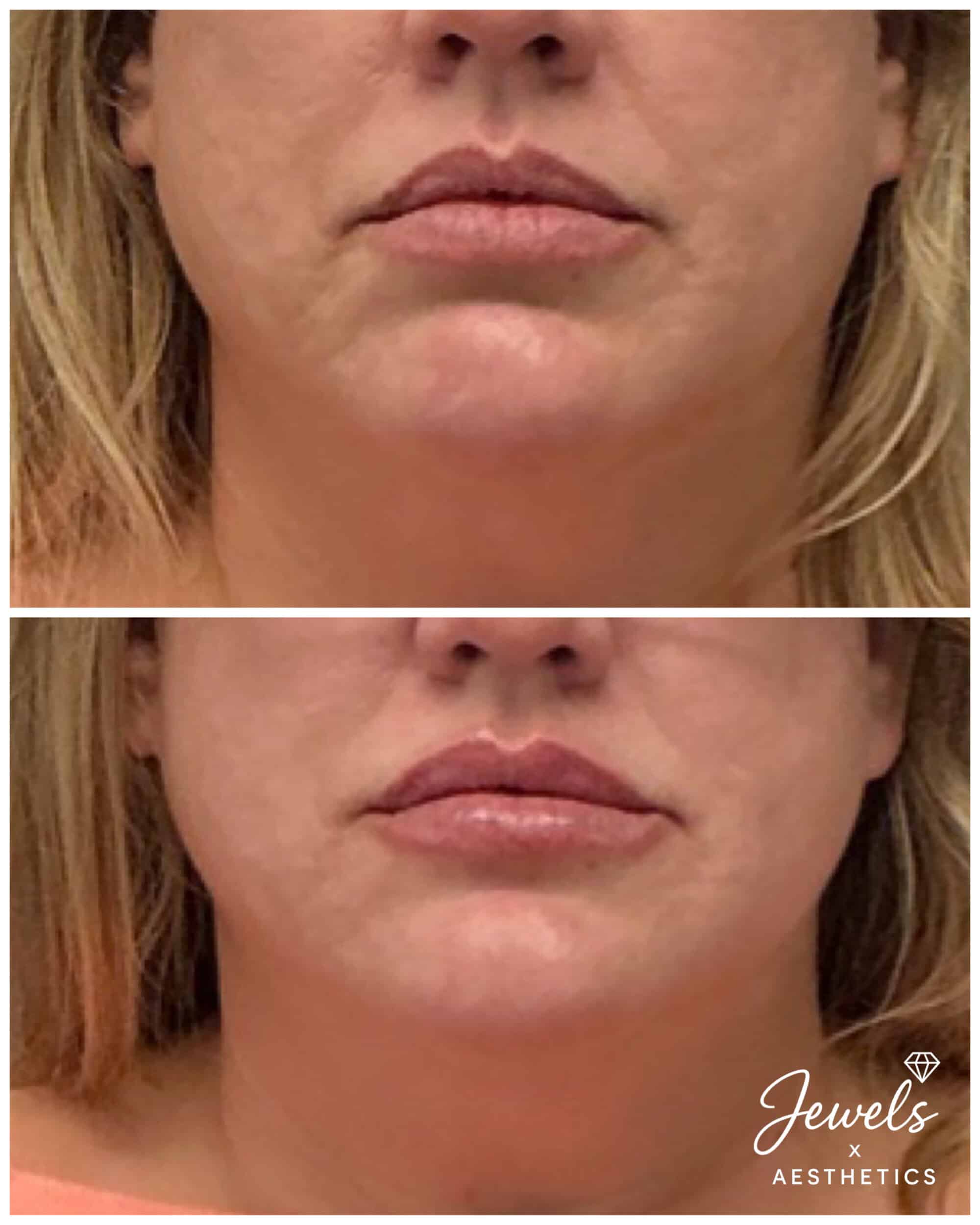 Before and After Image: Lip Filler - front