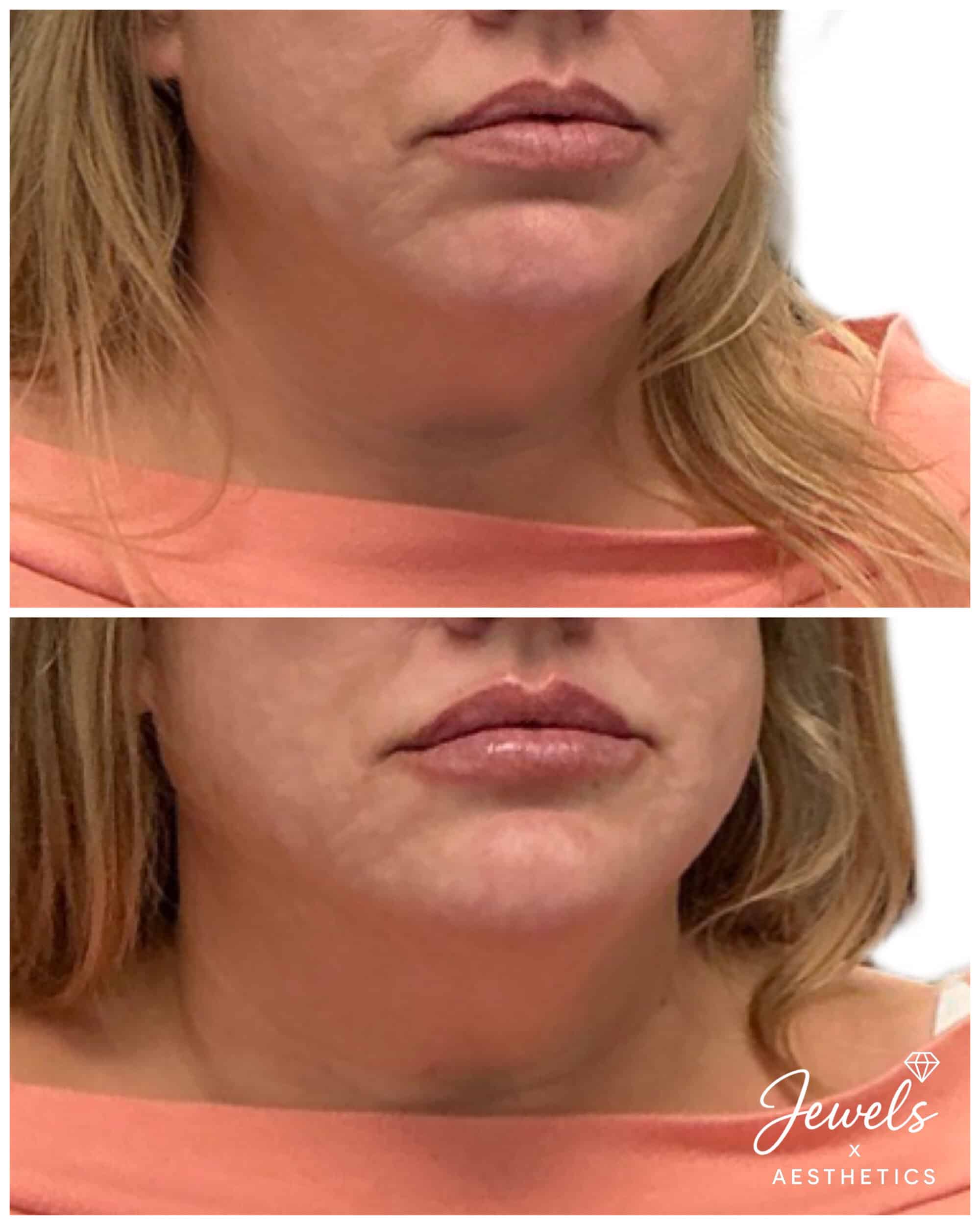 Before and After Image: Lip Filler - right-front-oblique