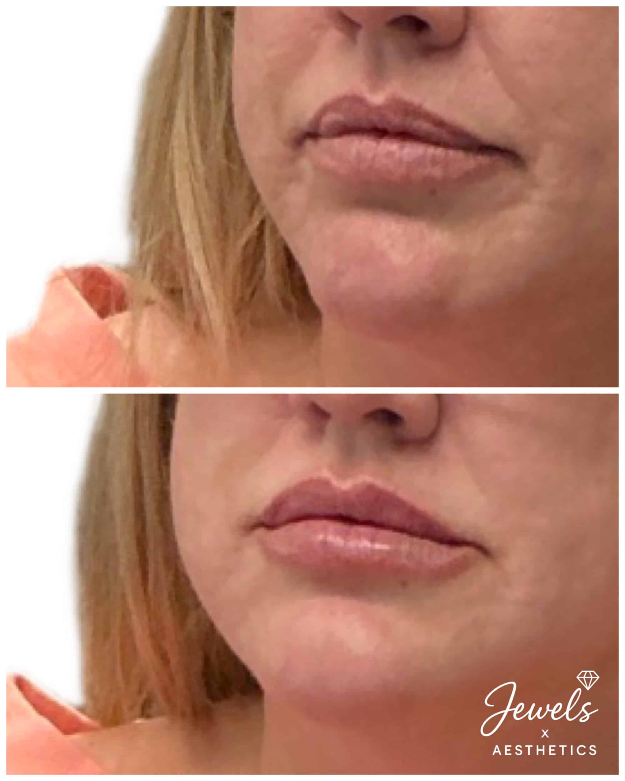 Before and After Image: Lip Filler - left-front-oblique