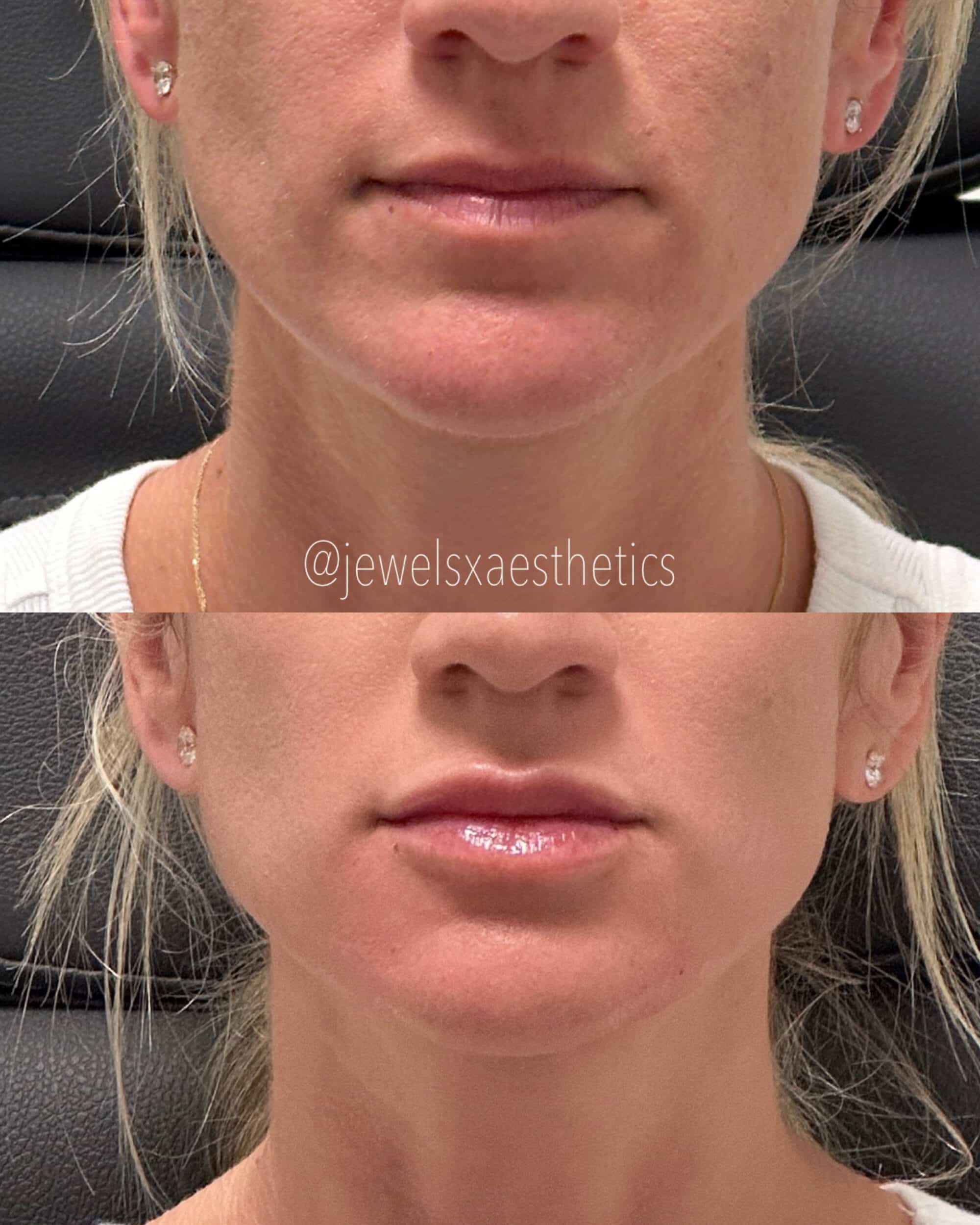 Before and After Image: Lips + Dermal Filler - front