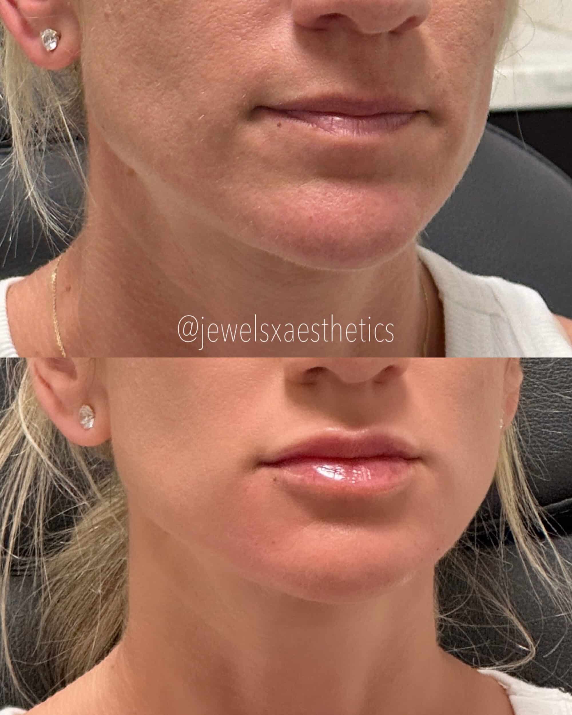 Before and After Image: Lips + Dermal Filler - right-front-oblique