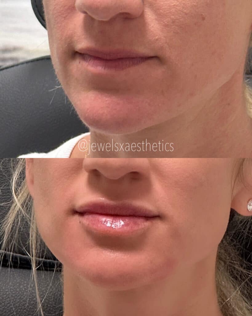 Before and After Image: Lips + Dermal Filler - left-front-oblique