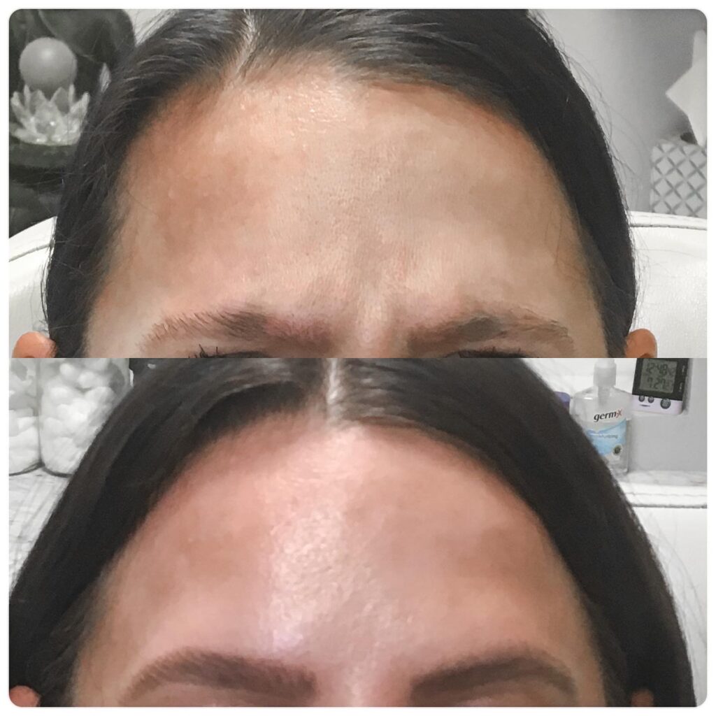 Before and After Image: Neuromodulators - front