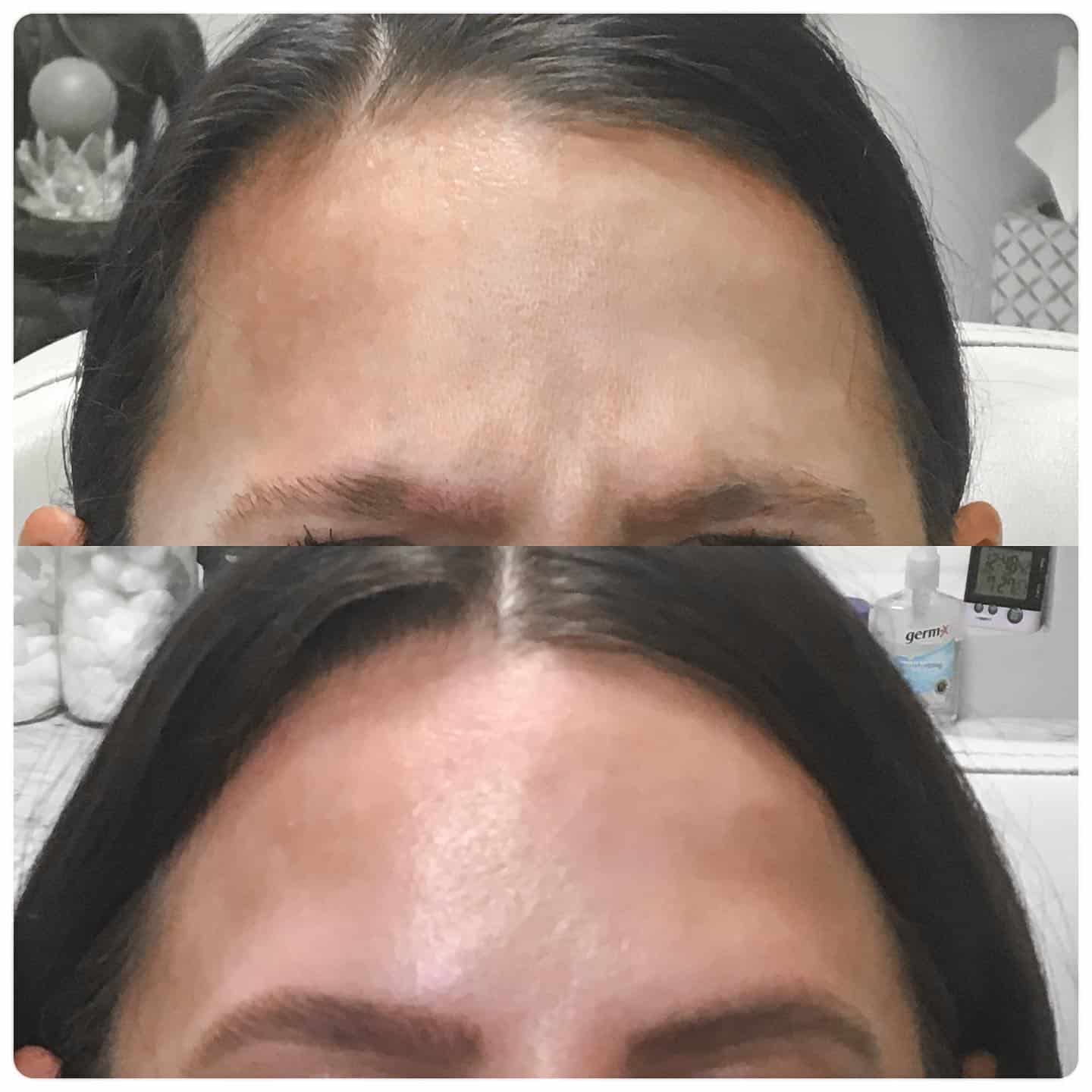 Before and After Image: Neuromodulators - front