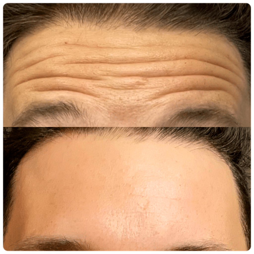 Before and After Image: Neuromodulators - front