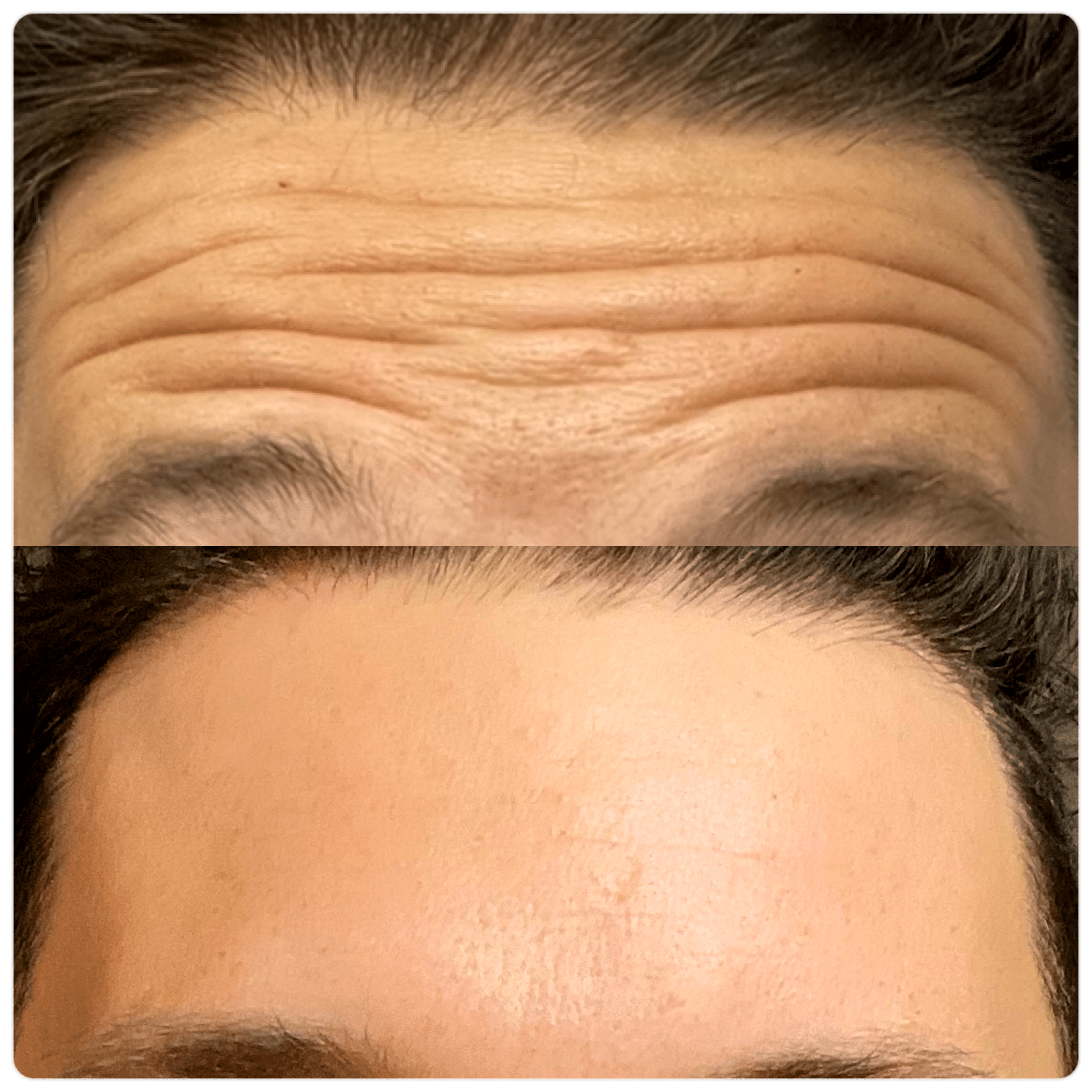 Before and After Image: Neuromodulators - front