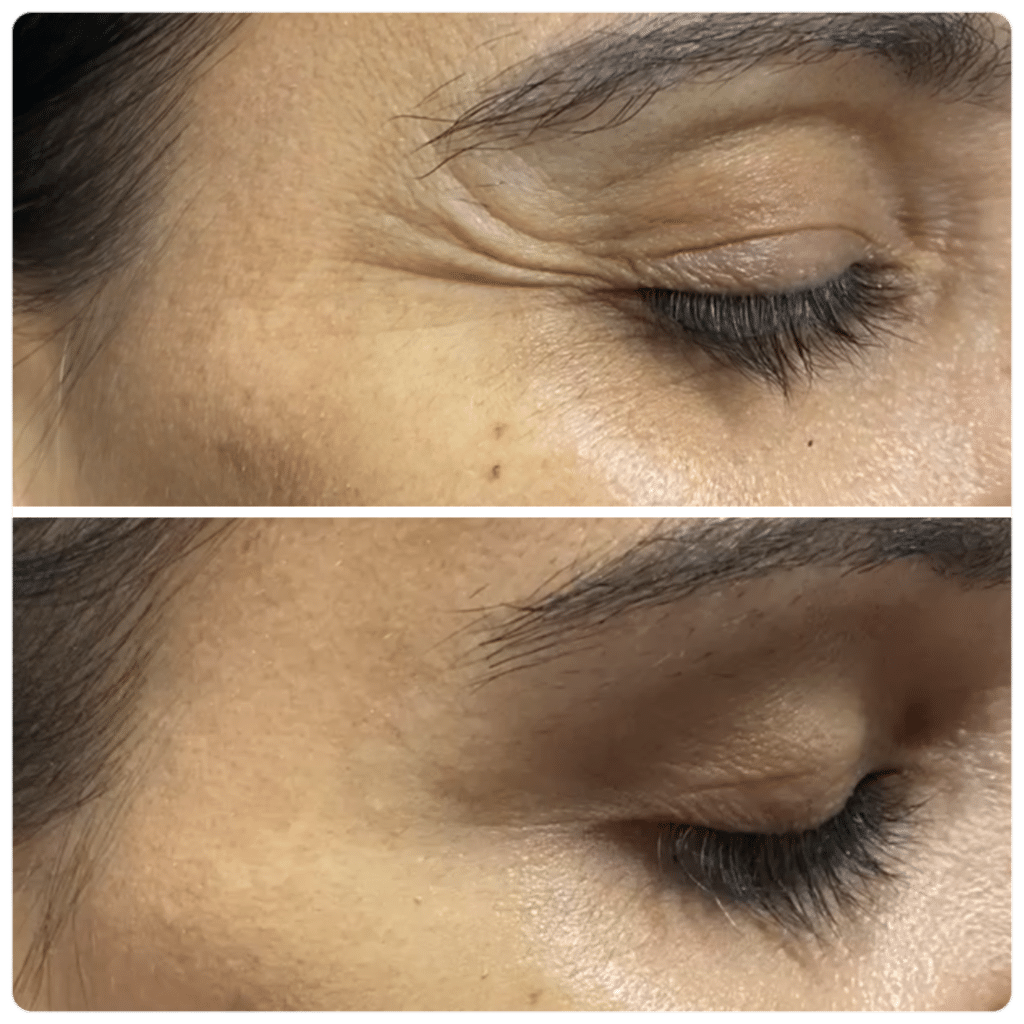 Before and After Image: Neuromodulators - right-front-oblique
