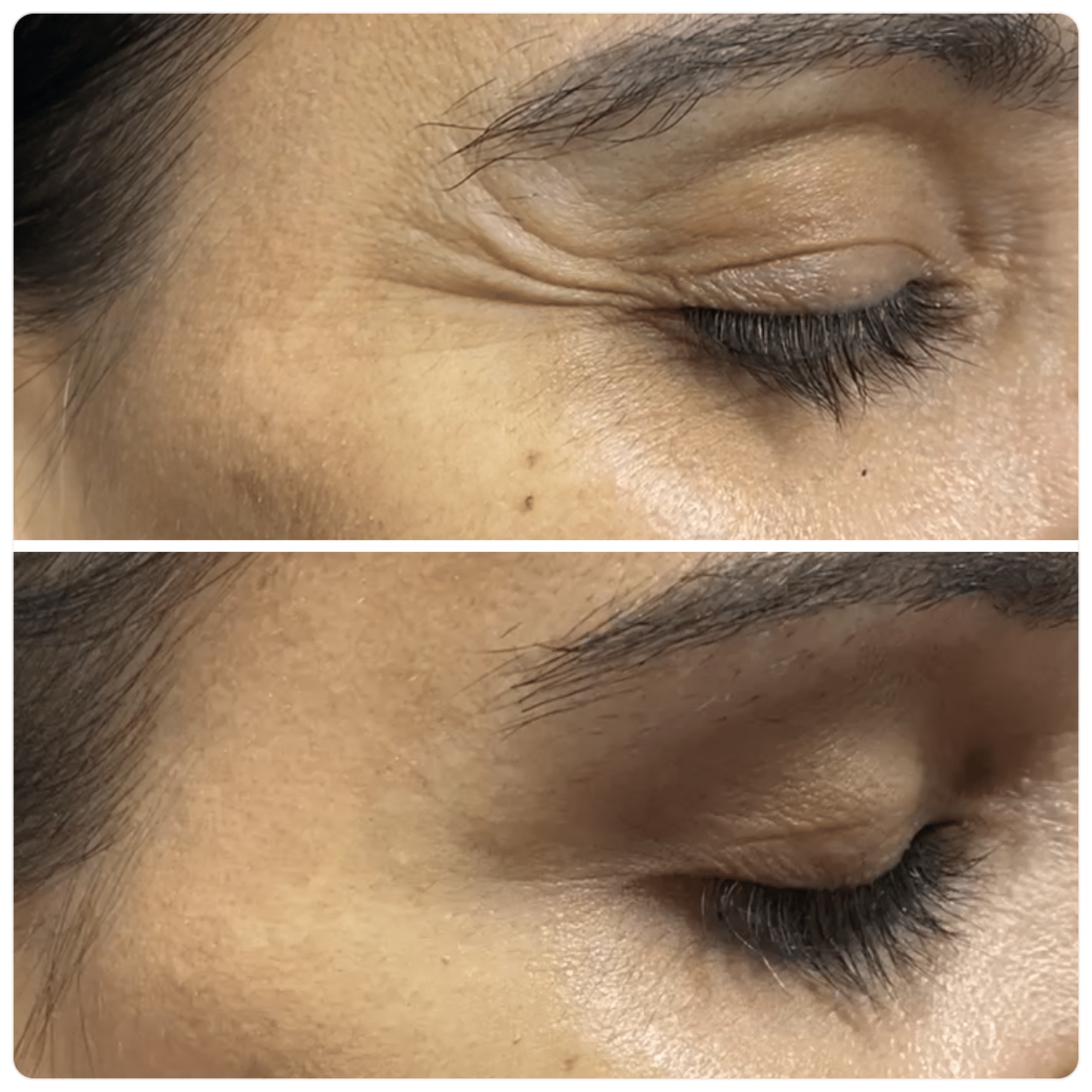 Before and After Image: Neuromodulators - right-front-oblique