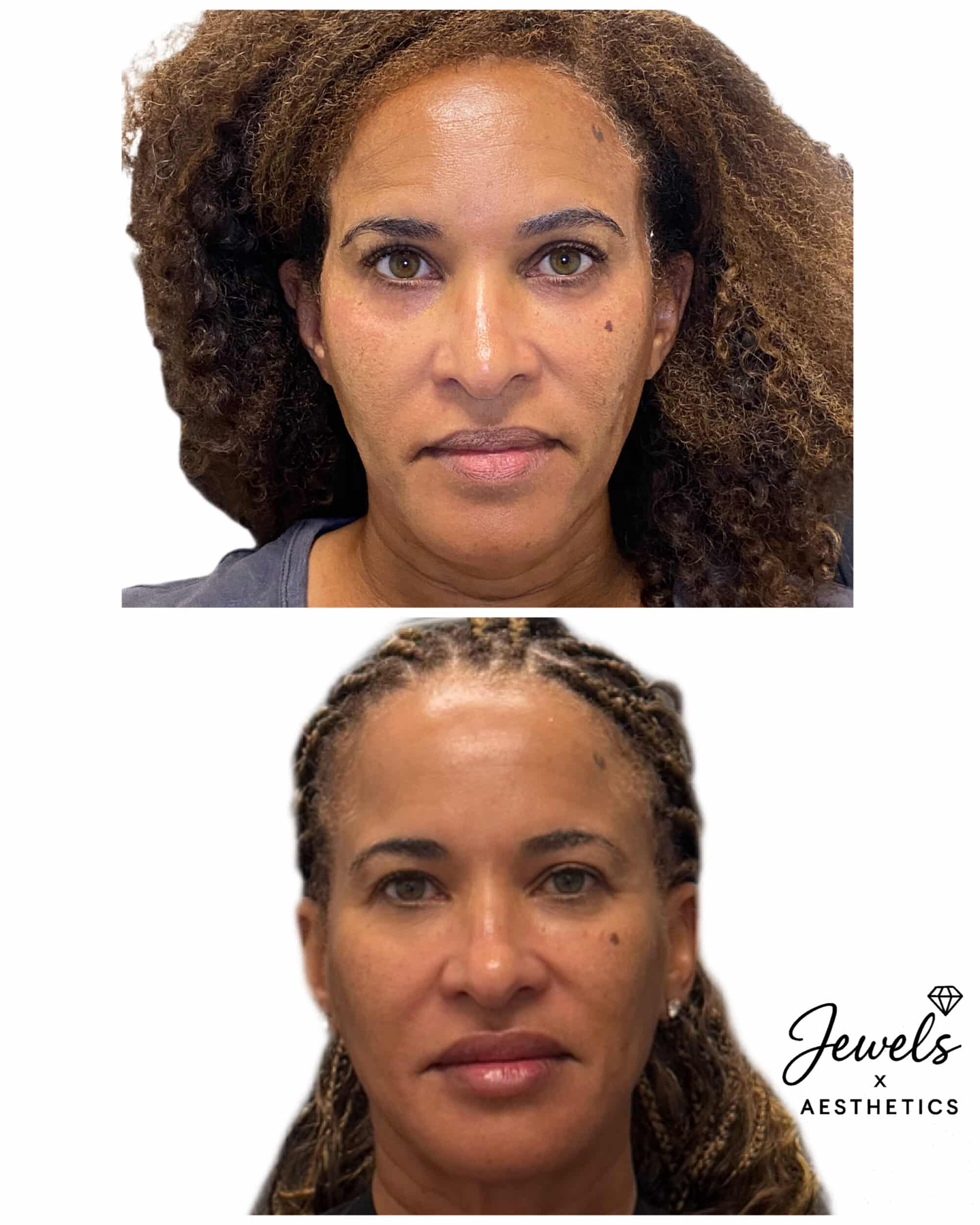 Before and After Image: Sculptra - front