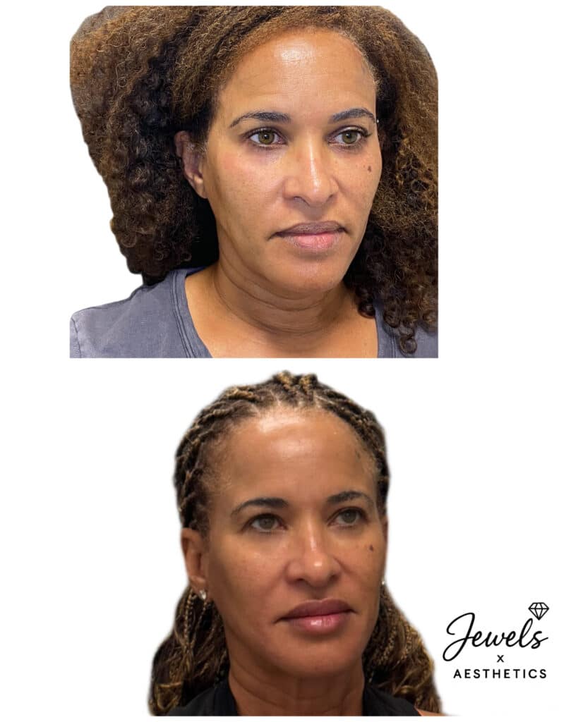 Before and After Image: Sculptra - right-front-oblique