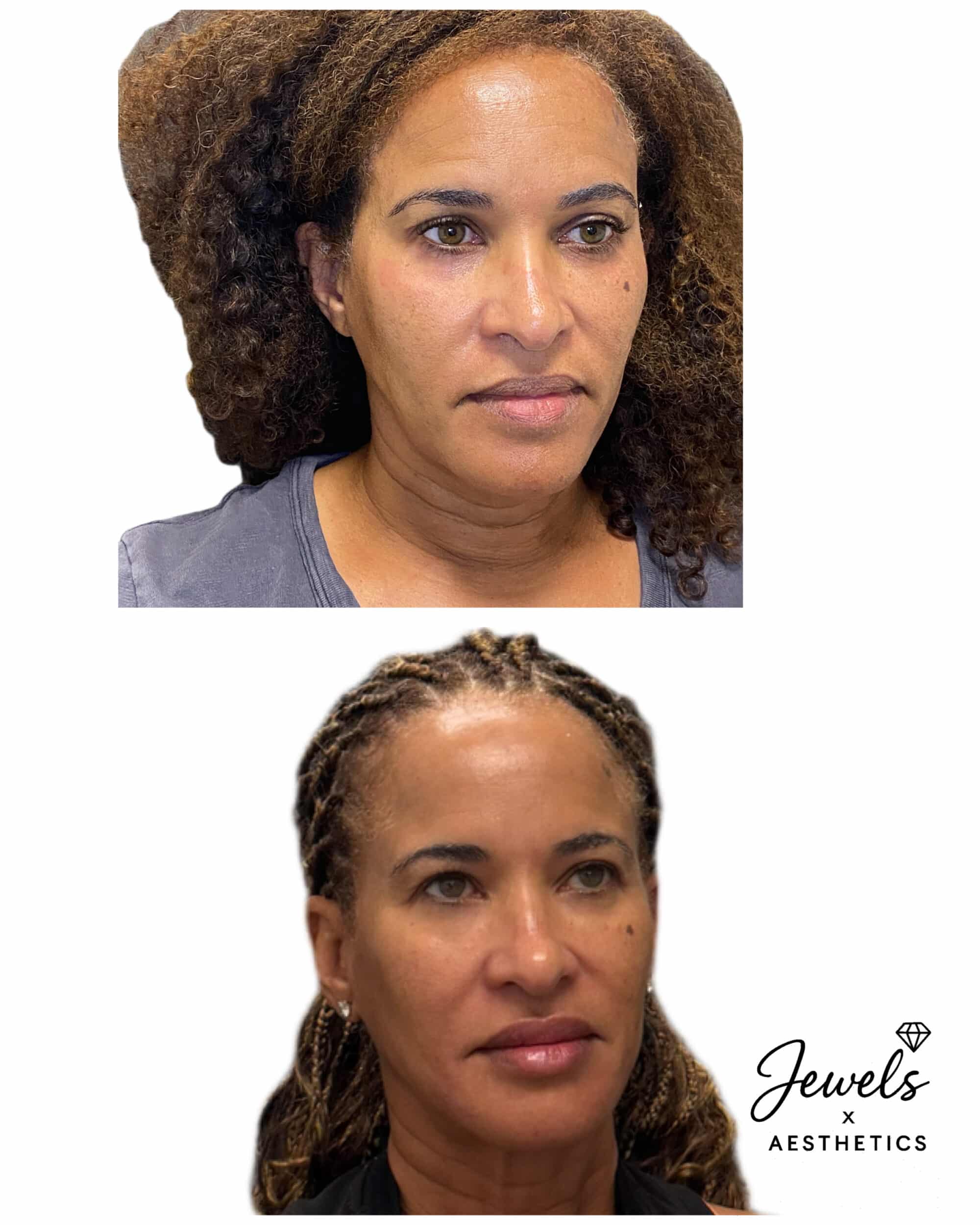 Before and After Image: Sculptra - right-front-oblique