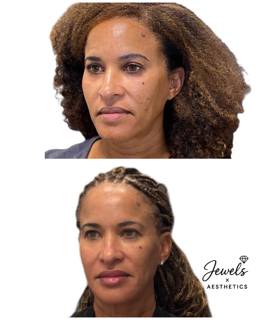 Before and After Image: Sculptra - left-front-oblique