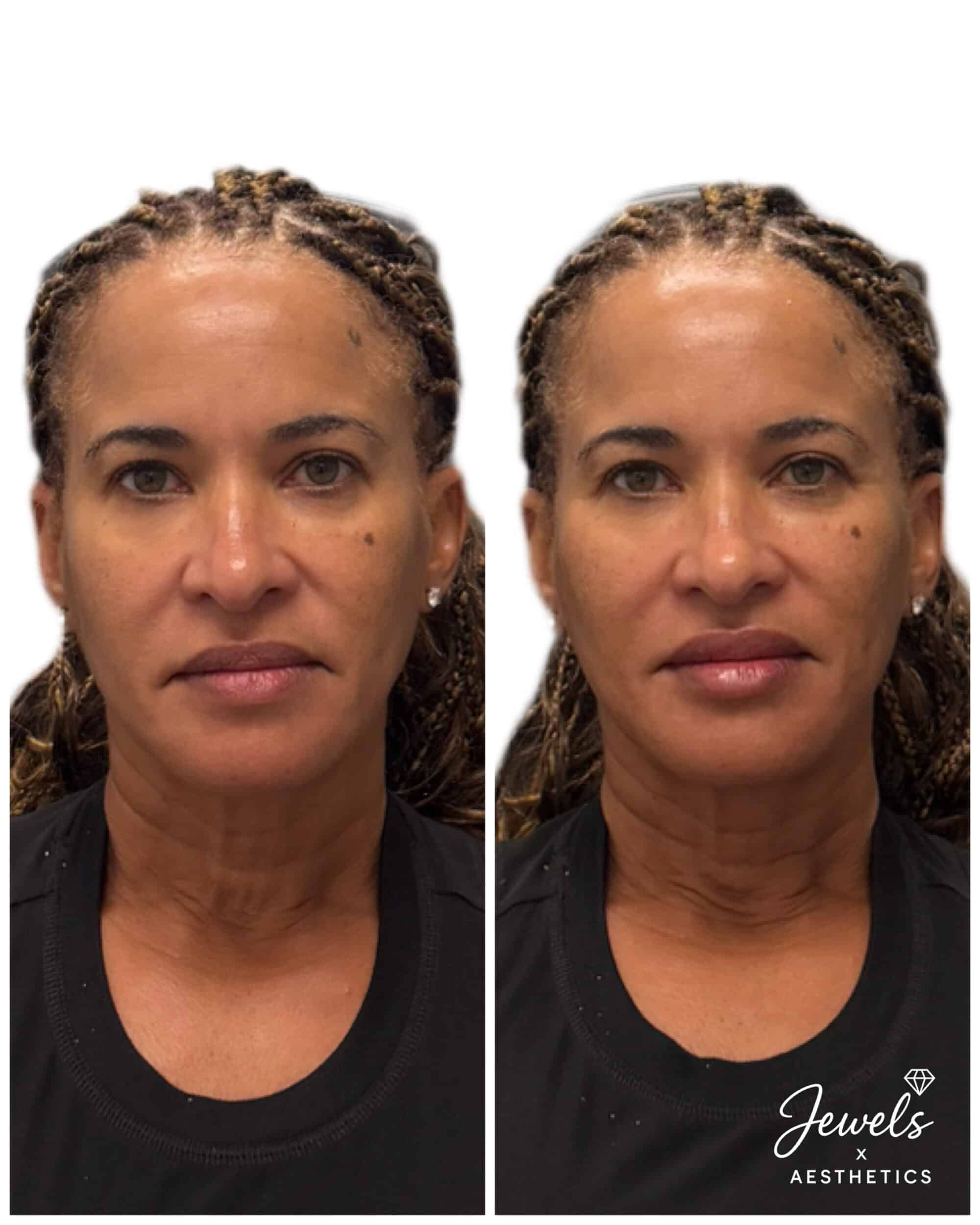 Before and After Image: Sculptra - front
