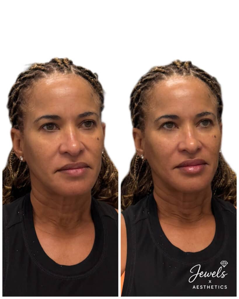 Before and After Image: Sculptra - right-front-oblique