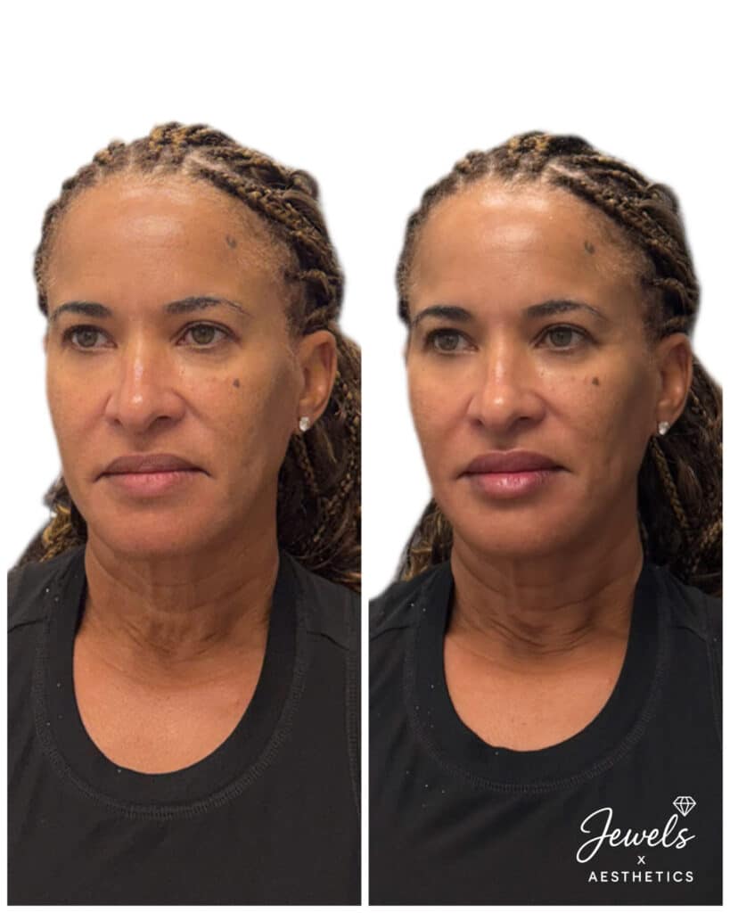 Before and After Image: Sculptra - left-front-oblique