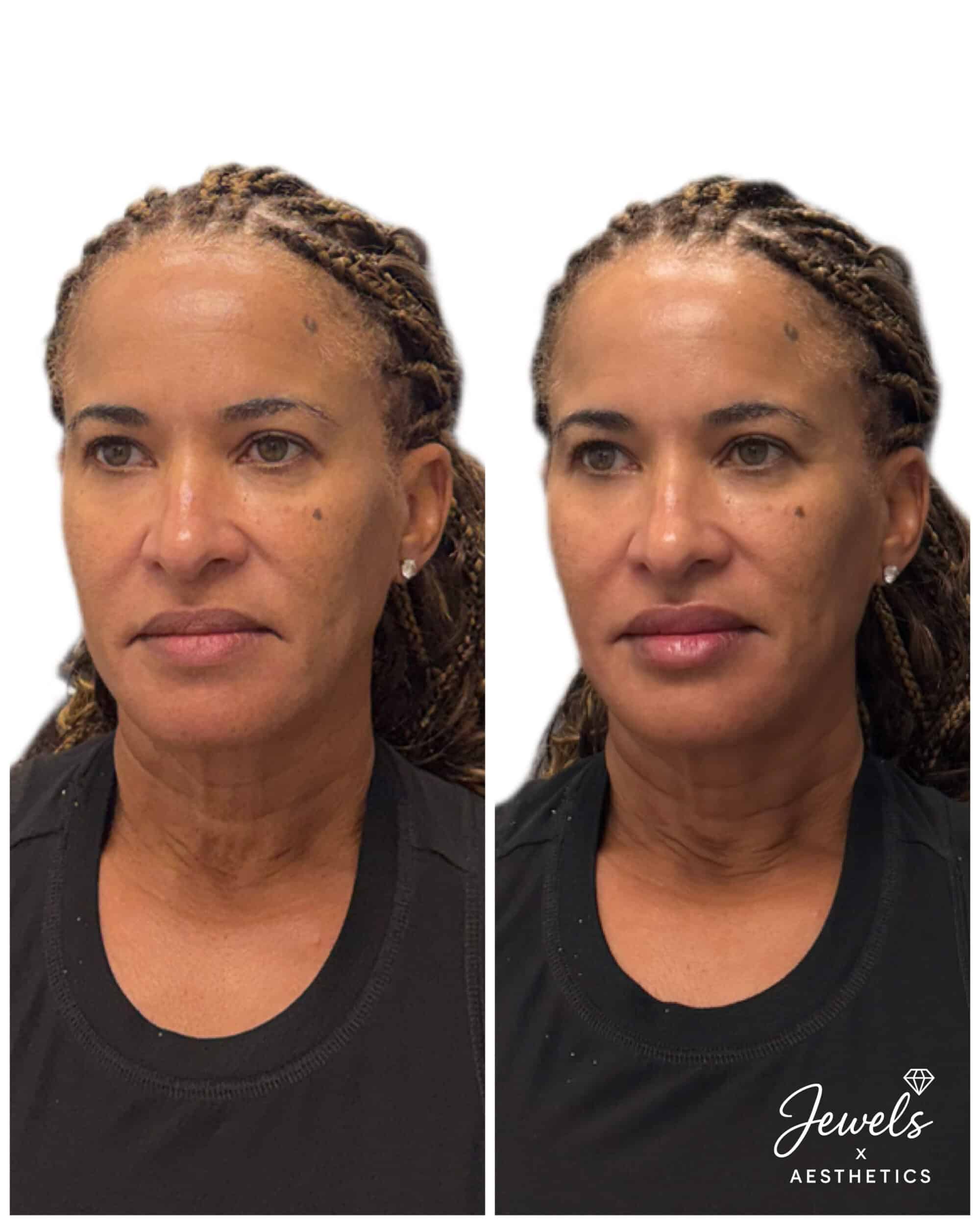 Before and After Image: Sculptra - left-front-oblique