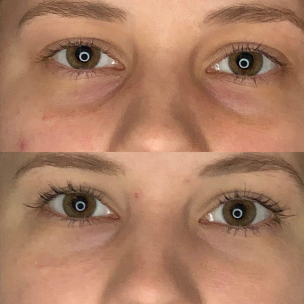 Before and After Image: Under-Eye Filler - front