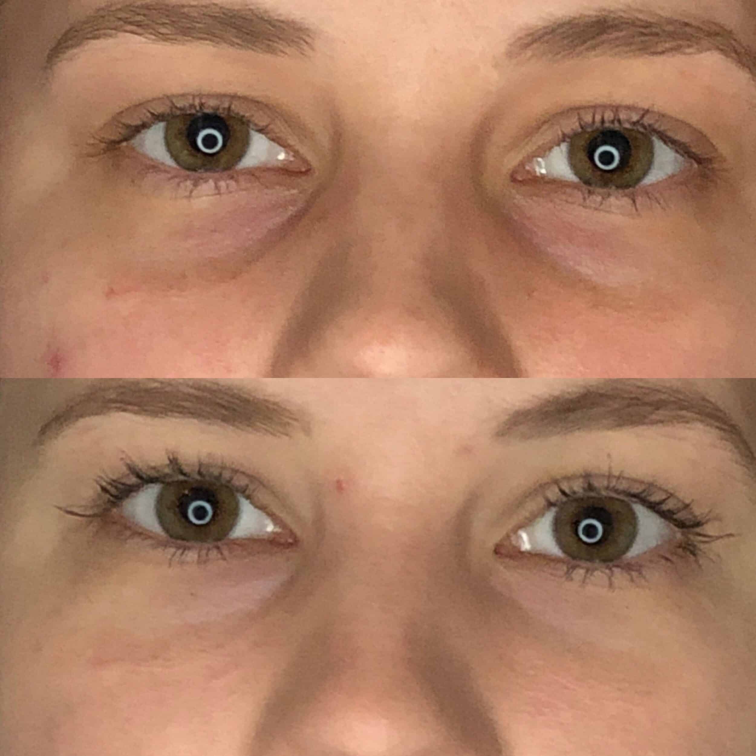 Before and After Image: Under-Eye Filler - front