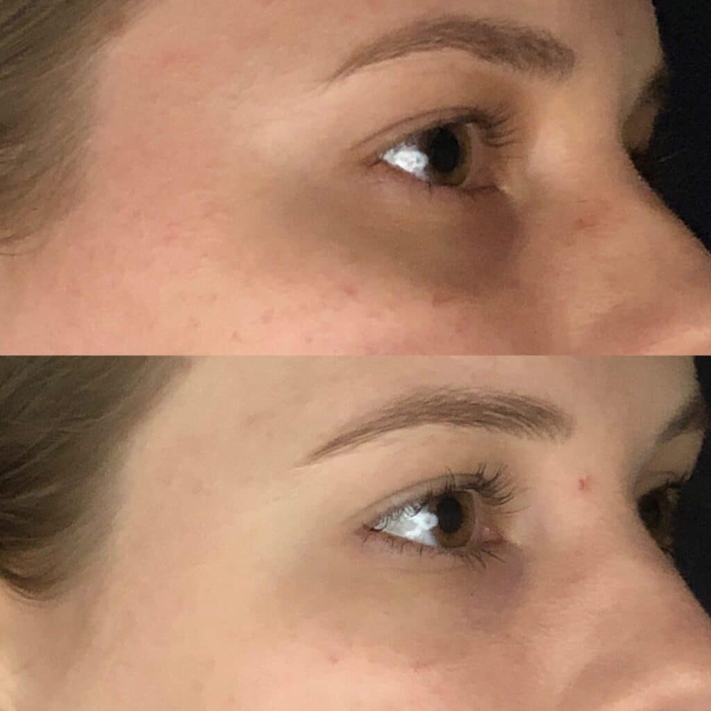 Before and After Image: Under-Eye Filler - right-front-oblique