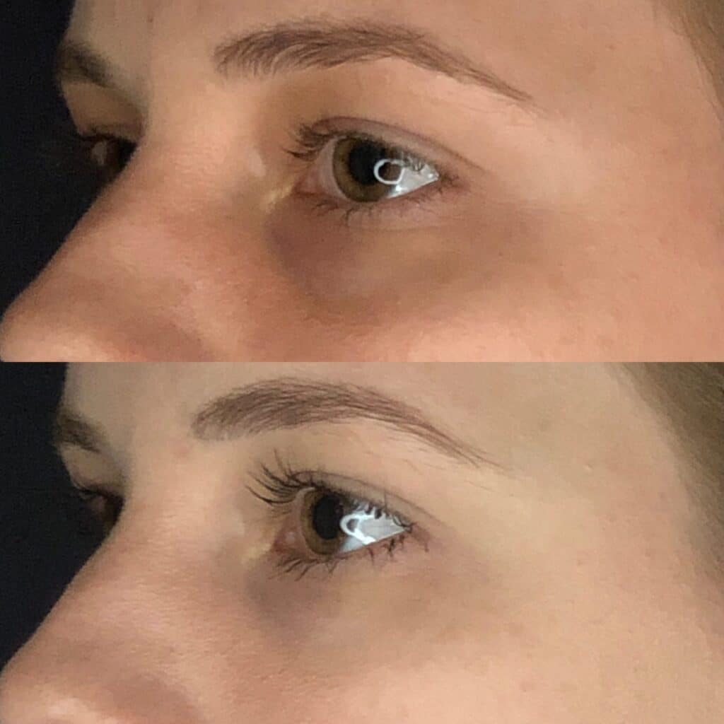 Before and After Image: Under-Eye Filler - left-front-oblique