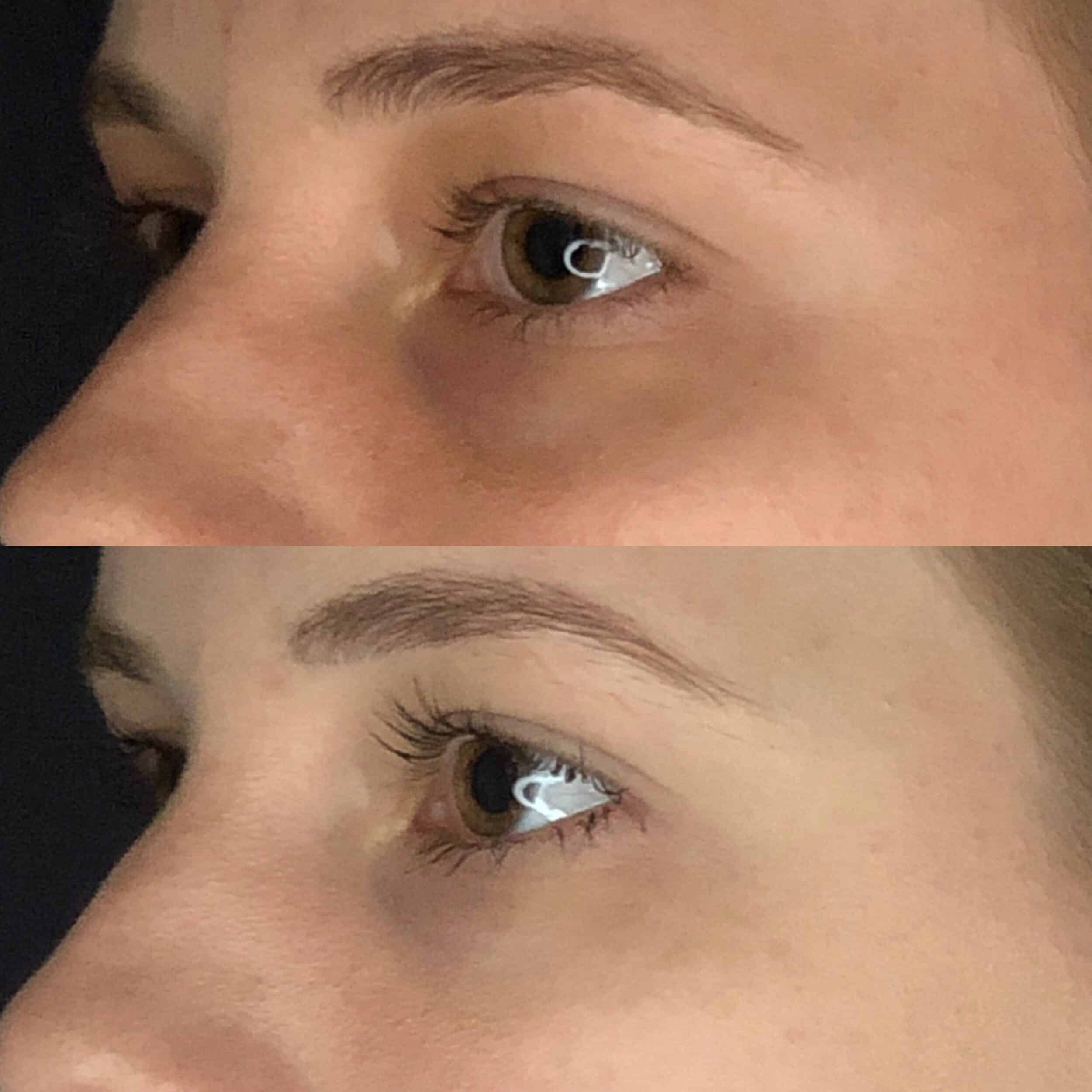 Before and After Image: Under-Eye Filler - left-front-oblique