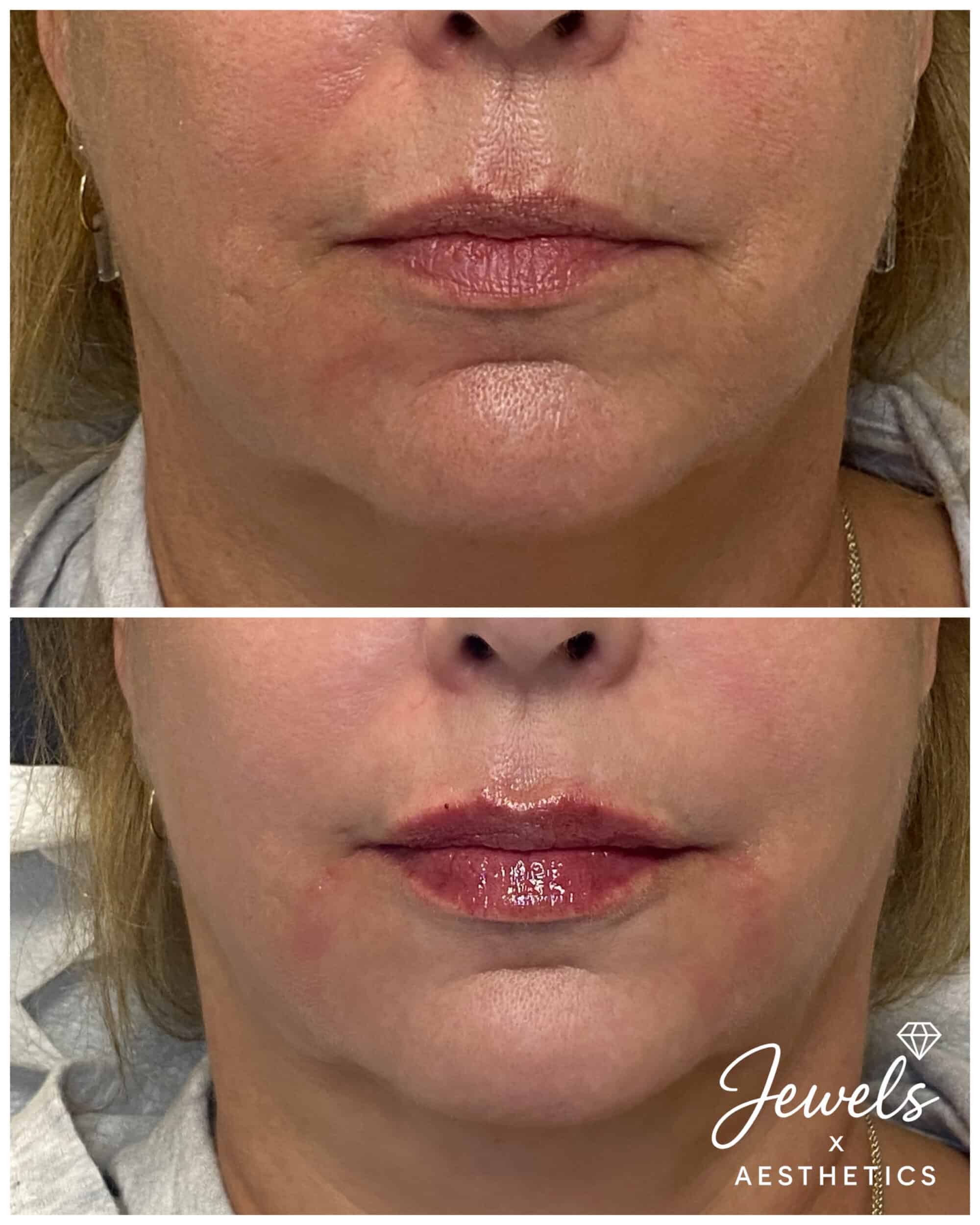 Before and After Image: Lips + Dermal Filler - front