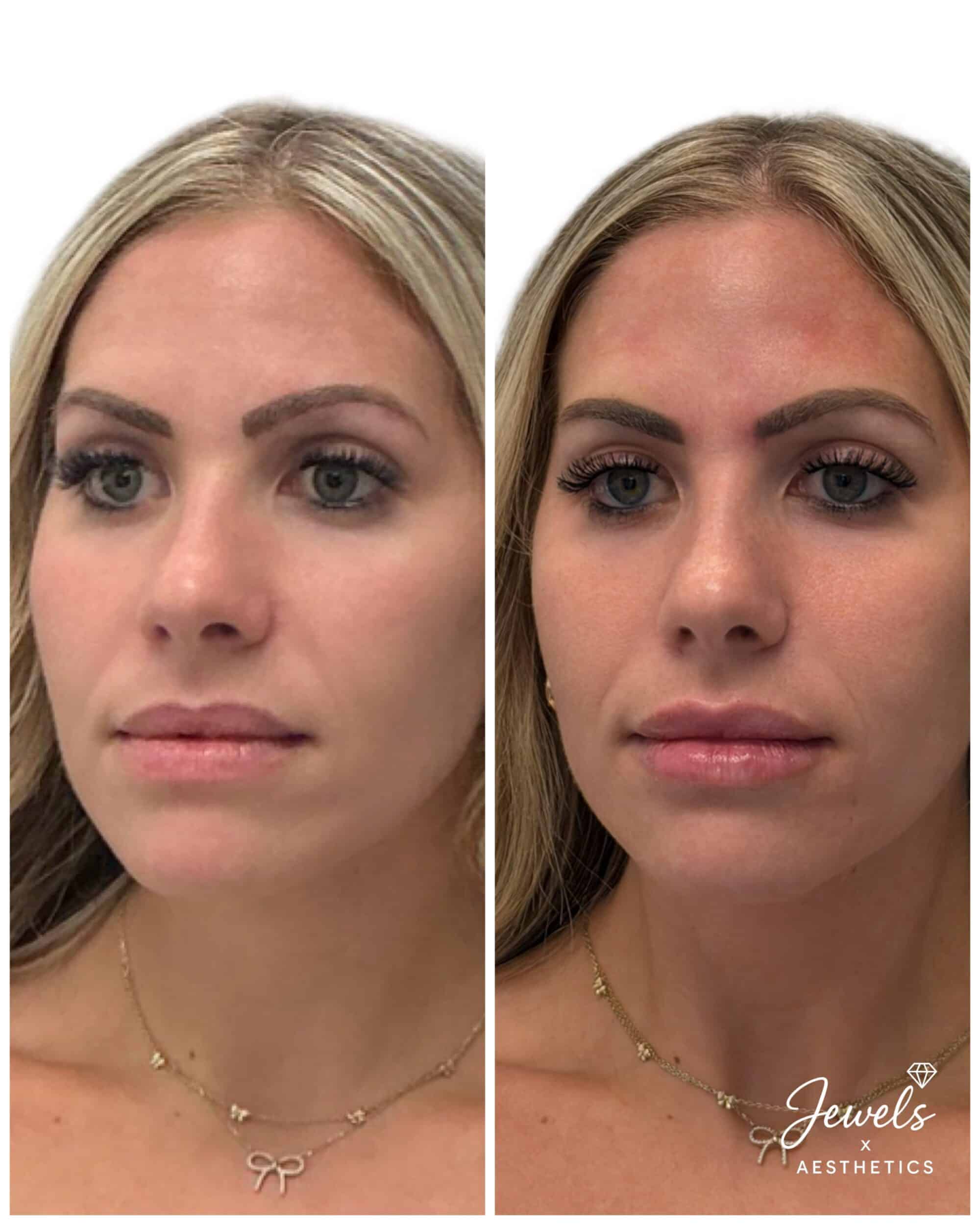 Before and After Image: Facial Balancing - left-front-oblique