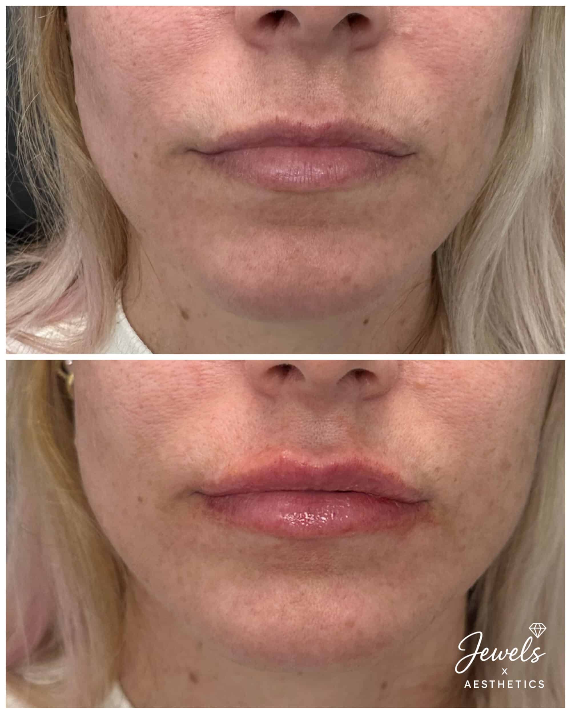 Before and After Image: Lip Filler - front