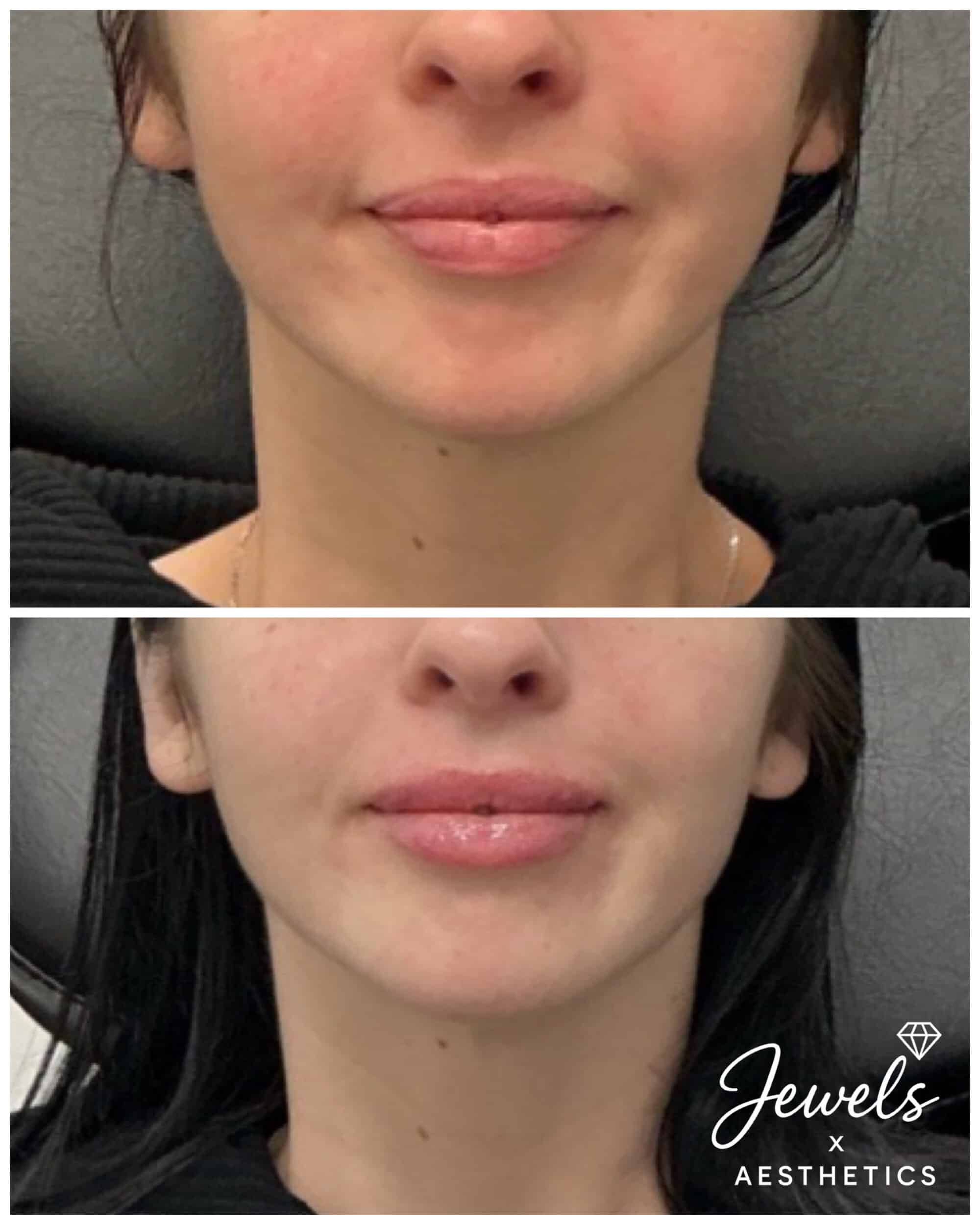 Before and After Image: Lip Filler - front