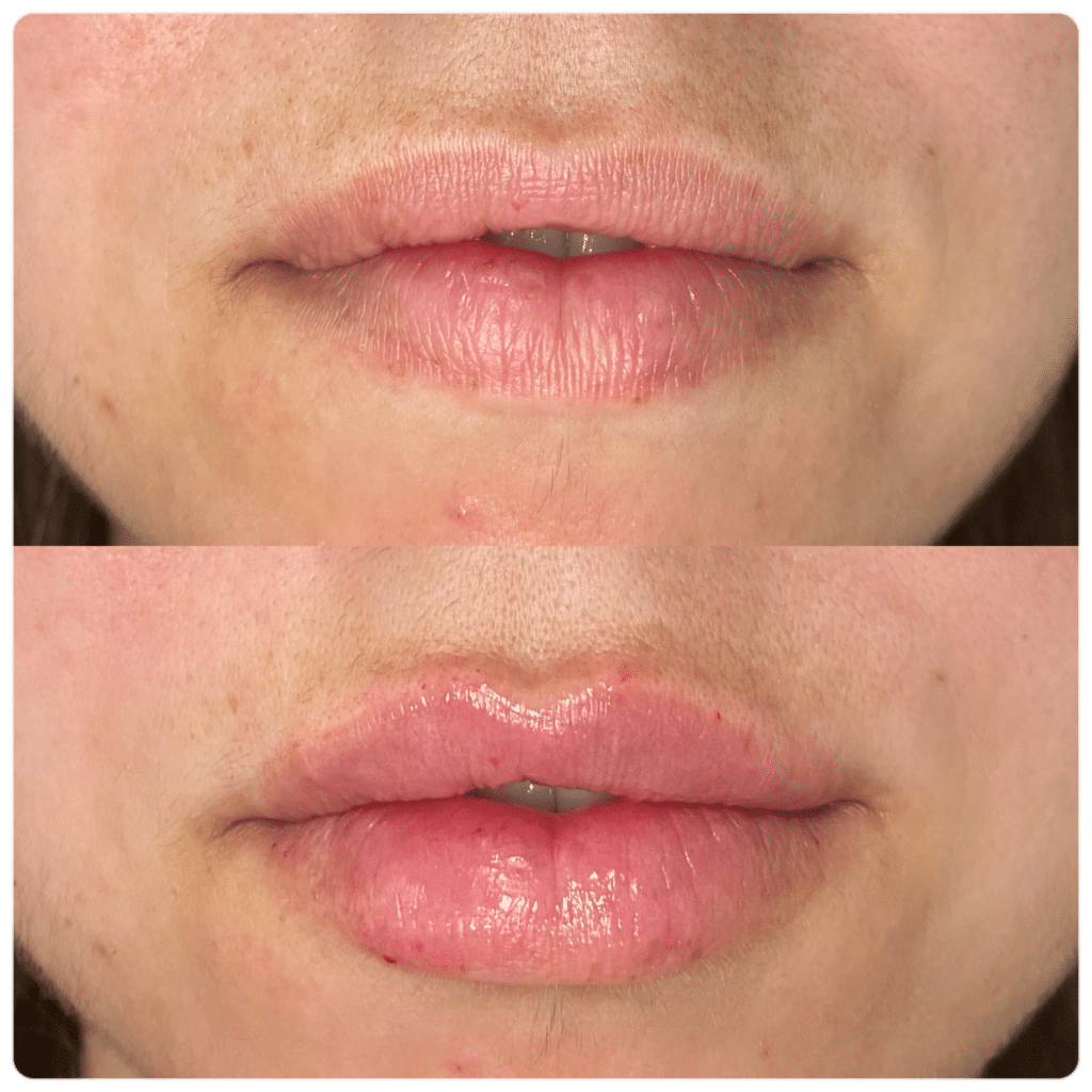Before and After Image: Lip Filler - front