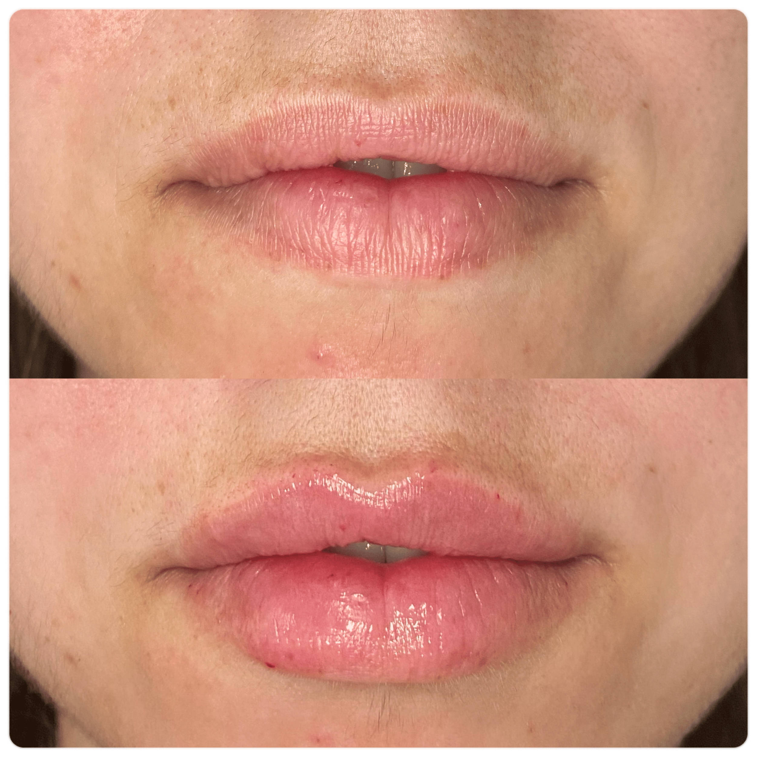 Before and After Image: Lip Filler - front